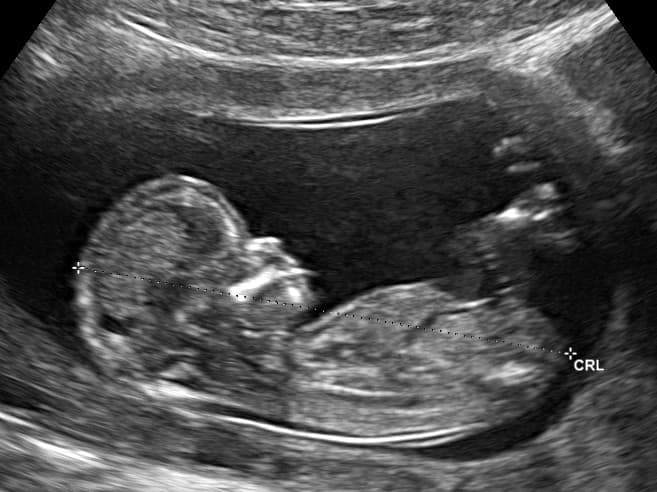 Ecografía real de un bebé de 12 semanas de perfil