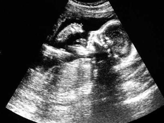 Ecografía real del perfil de un feto de 20 semanas.