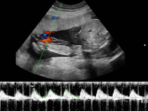 Ecografía doppler real del cordón umbilical, con el flujo en color y la curva de velocidad abajo.